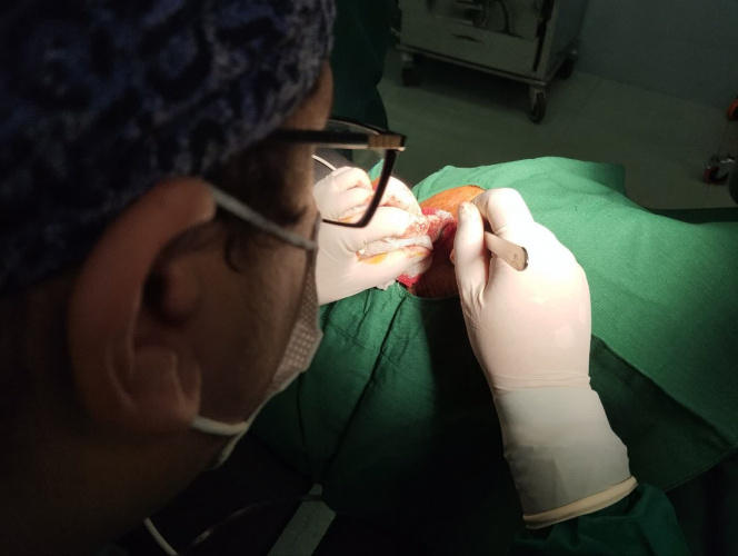 عمل جراحی خارج کردن کیست(سینوس پیلونیدال)