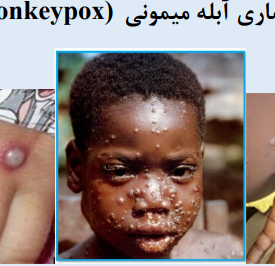 آبله میمونی