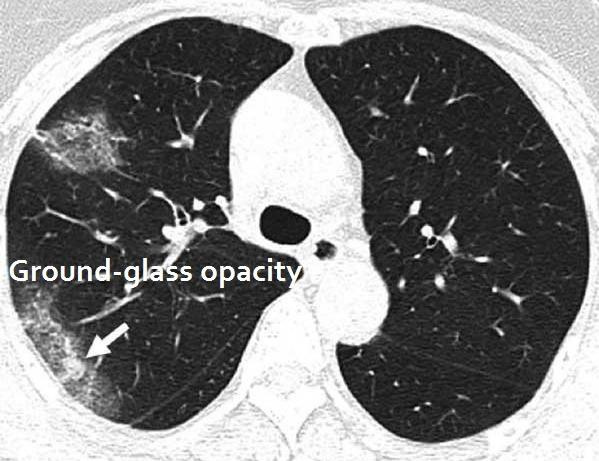 بیماری کرونا در سی تی اسکن چگونه نشان داده میشود؟