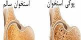 پیشگیری از پوکی استخوان