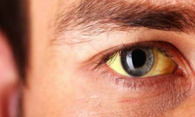 زردی در بزرگسالان و کودکان