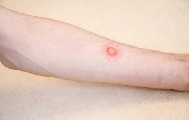 ۱۰ درمان خانگی برای بیماری پوستی کرم حلقوی