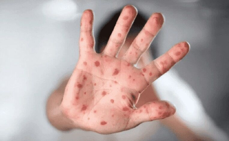 تاثیر ۸۵ درصدی واکسیناسیون علیه آبله در پیشگیری از آبله میمون (Monkeypox)